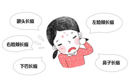 脸上长痘痘要注意做好这几点