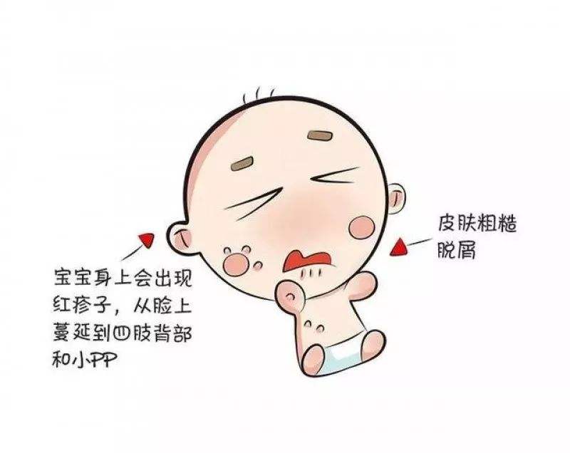 宝宝患湿疹要注意什么呢