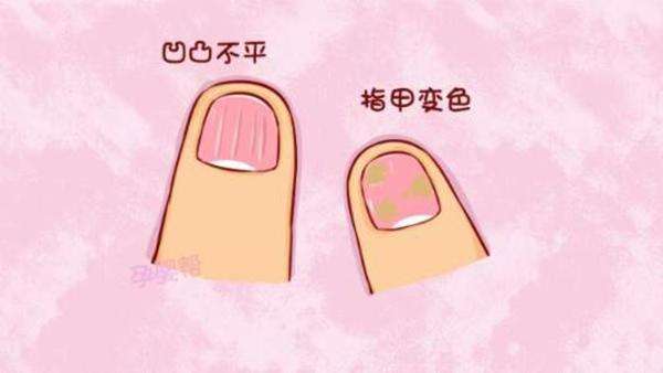 灰指甲的一些生活常识