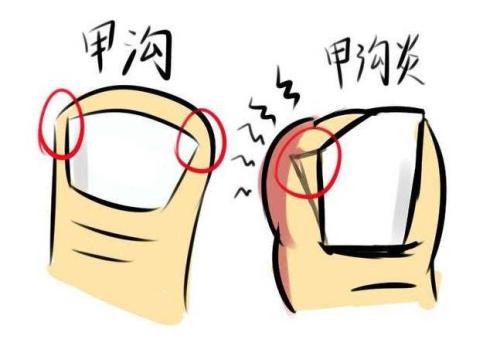 甲沟炎是怎么形成的