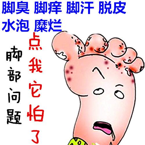 脚气的治疗方法有哪些