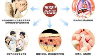 西安治疗灰指甲的医院哪家好